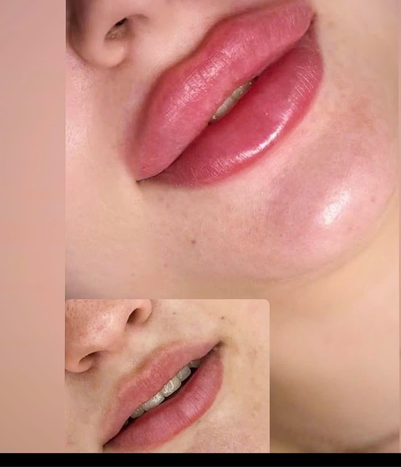 file lip